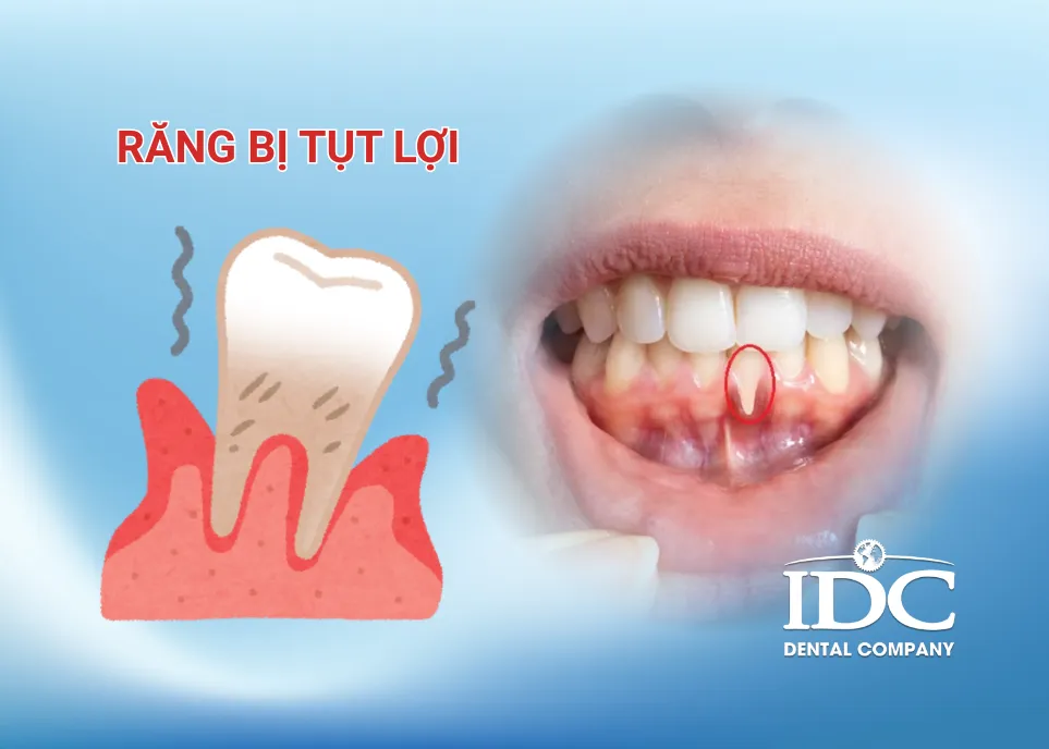 Răng tụt lợi là gì? 