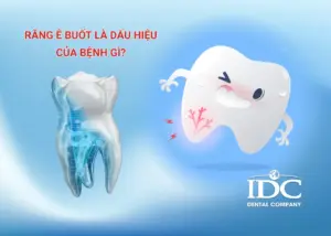 Mão răng sứ là gì? Cấu tạo, ưu nhược điểm và khi nào nên làm