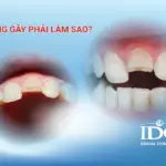 rang gay phai lam sao
