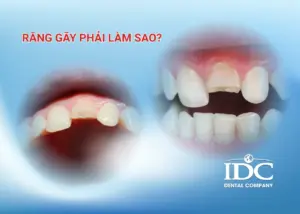 Vì sao bọc răng sứ bị đau nhức? 5 Nguyên nhân thường gặp