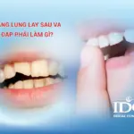 Răng lung lay sau va đập phải làm gì?
