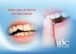 Mão răng sứ là gì? Cấu tạo, ưu nhược điểm và khi nào nên làm