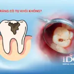 Răng sâu có tự khỏi không?