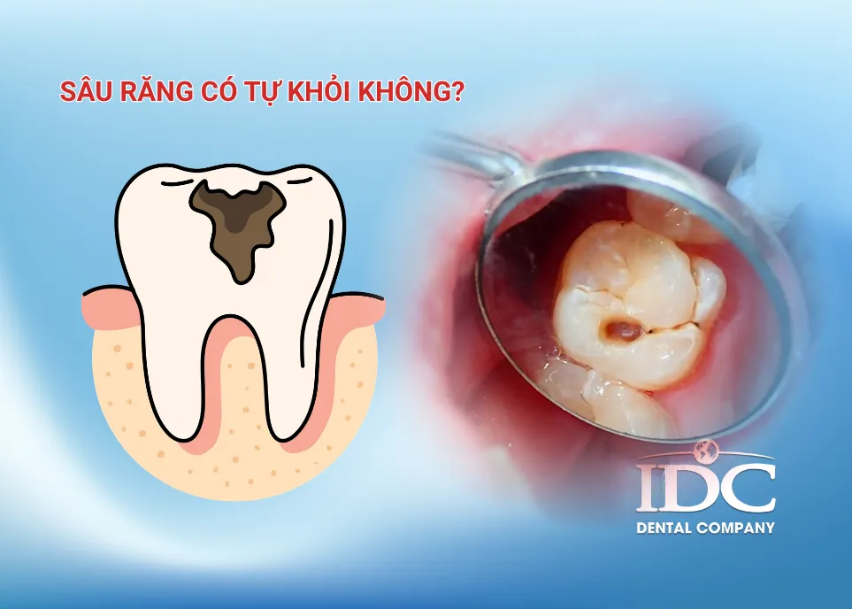 Răng sâu có tự khỏi không?