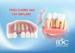 Răng bị mòn men răng phải làm sao? Nguyên nhân & cách khắc phục hiệu quả