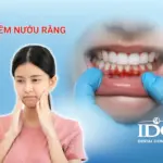 Viêm nướu răng là gì?