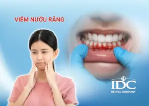 Áp xe răng là gì? Cách chữa trị an toàn và hiểu quả