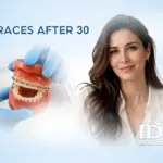 Braces After 30