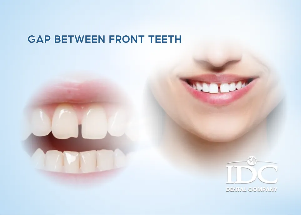 Gap Between Front Teeth