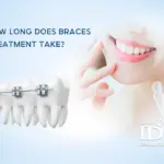 How long does braces treatment take