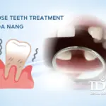 Loose Teeth Treatment in Da Nang