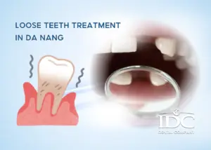 When Are Dental Veneers Necessary?