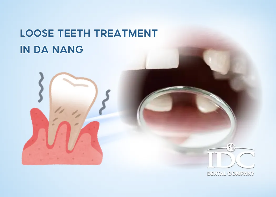 Loose Teeth Treatment in Da Nang