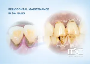 Dental Fillings