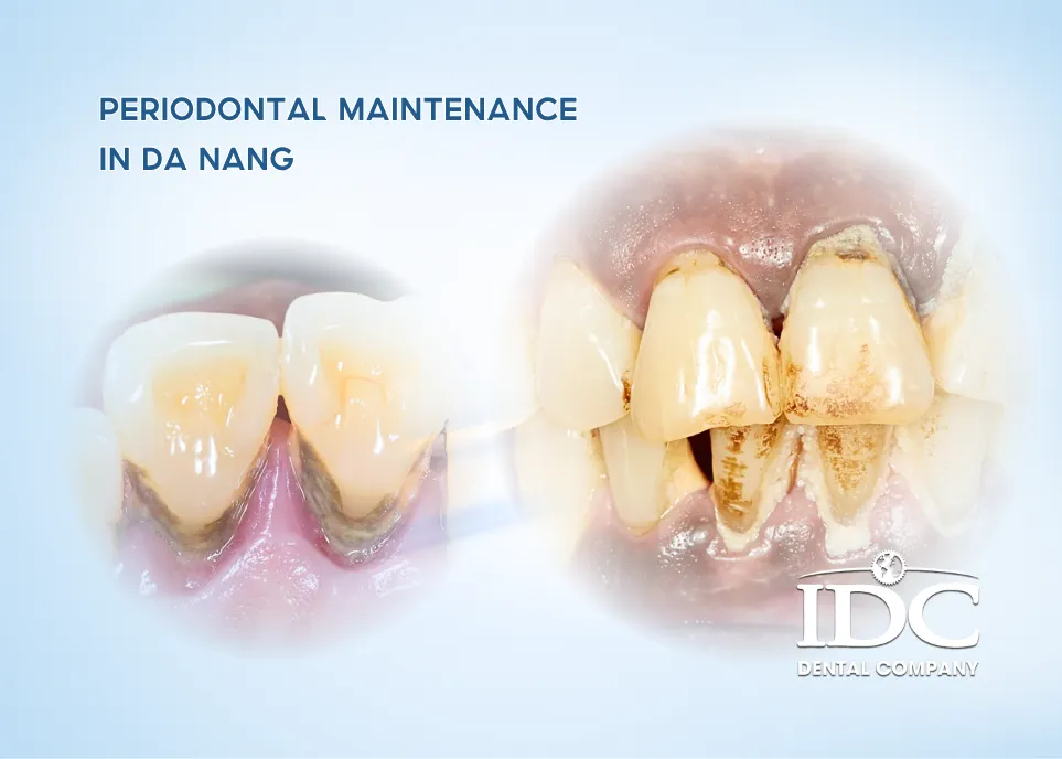 Periodontal Maintenance in Da Nang