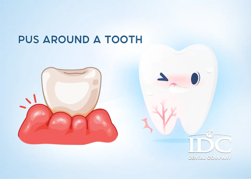 Pus Around a Tooth