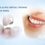 Replacing Dental Crowns in Da Nang