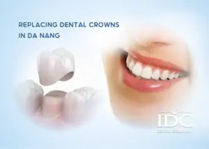 Teeth Whitening