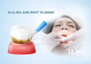 Teeth Cleaning in Da Nang City, Vietnam