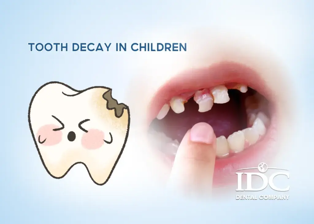 Tooth Decay in Children