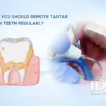 Why You Should Remove Tartar from Teeth Regularly