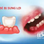 Bé bị sưng lợi là do đâu?