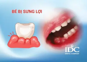 Răng sứ Lava Plus là gì? Ưu điểm, chi phí và có nên lựa chọn?