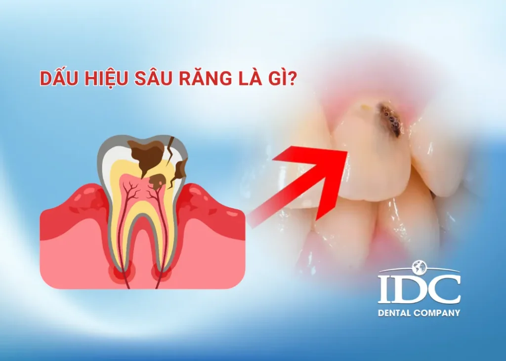 Dấu hiệu sâu răng là gì?