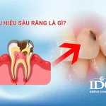 Dấu hiệu sâu răng là gì?