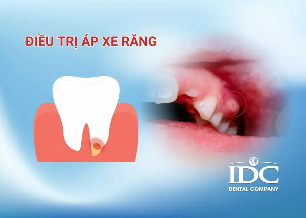 Điều trị áp xe răng