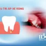 Điều trị áp xe răng
