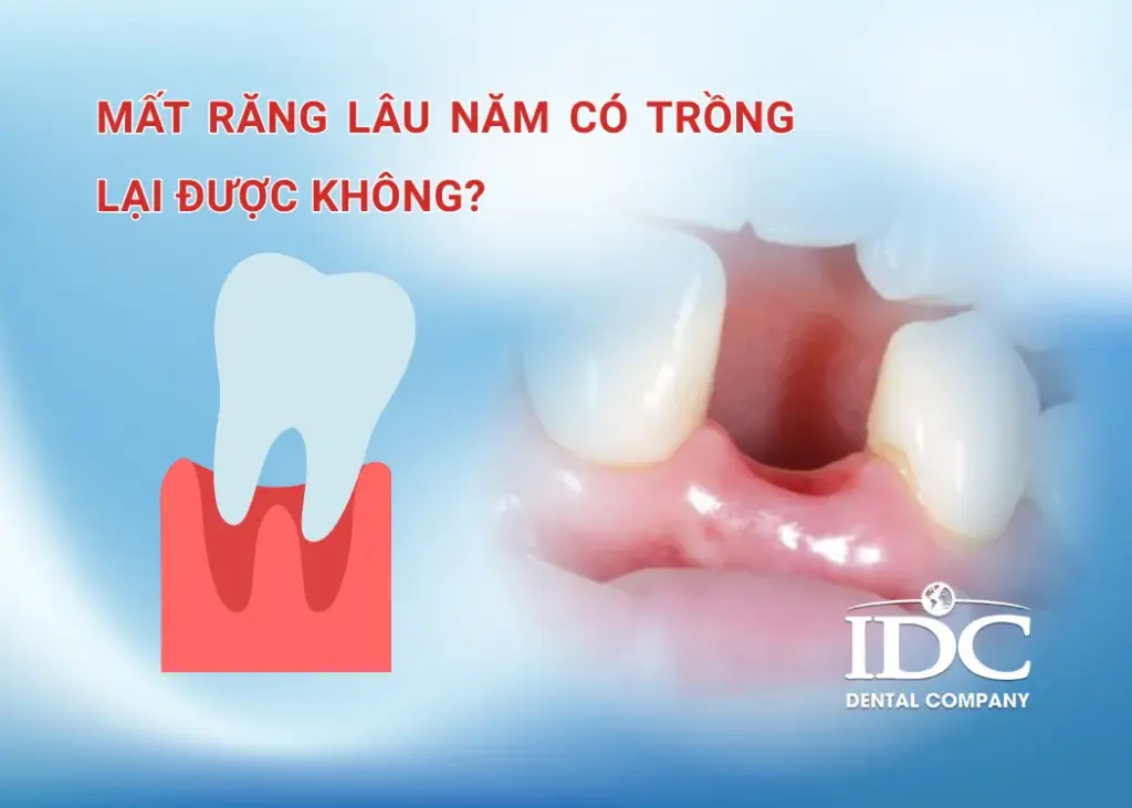 Mất răng lâu năm có trồng lại được không?