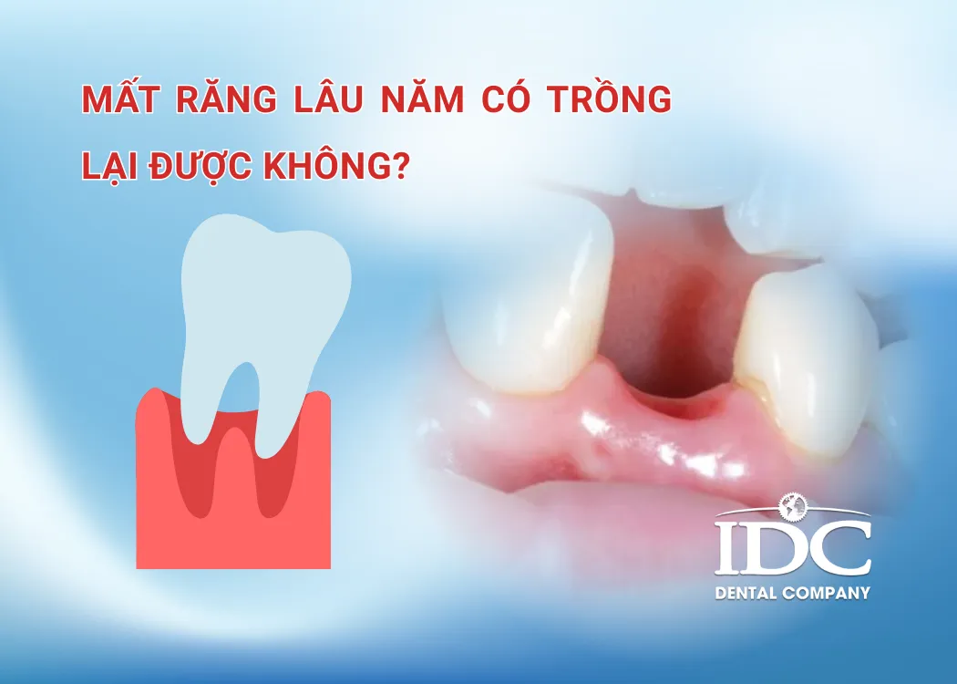 mat rang lau nam