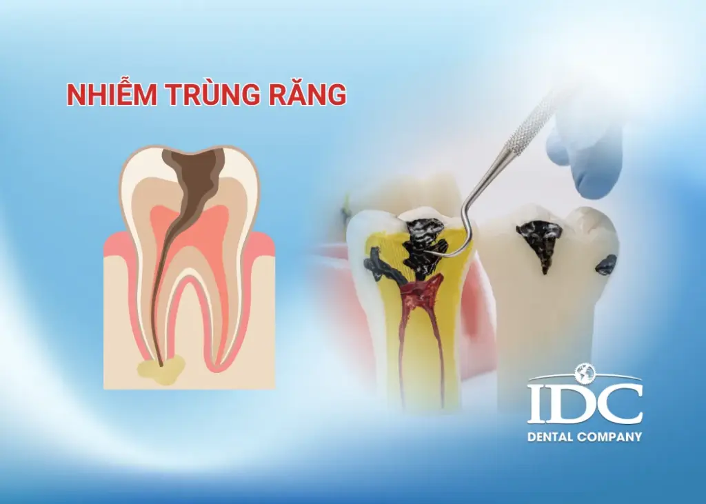 Nhiễm trùng răng là gì?