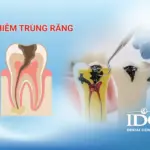 nhiem trung rang