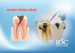 Mọc răng khôn đau mấy ngày mới hết? Cách nhận biết đau bình thường hay biết thường