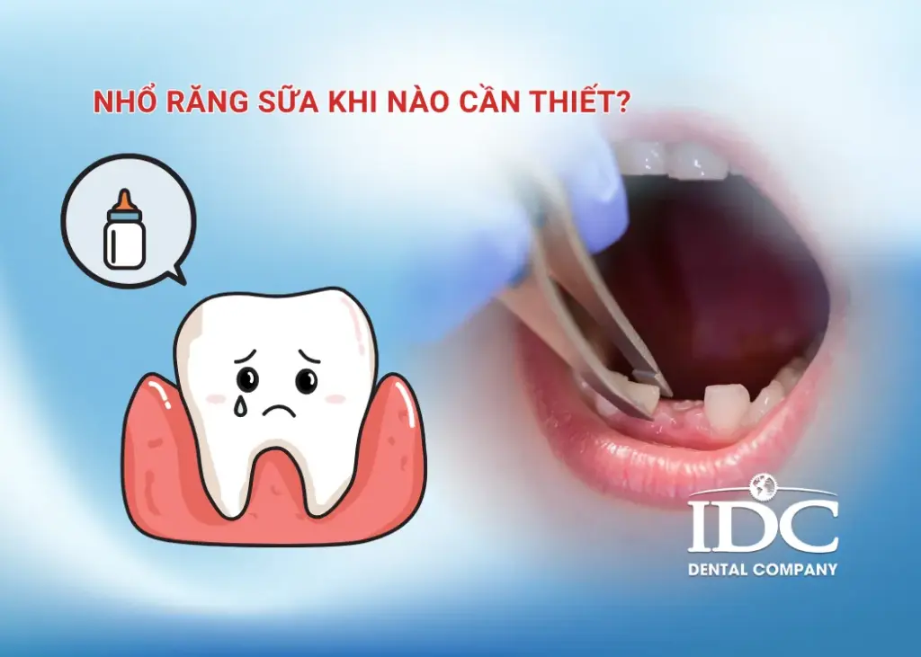 Nhổ răng sữa khi nào cần thiết?