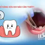 Nhổ răng sữa khi nào cần thiết?