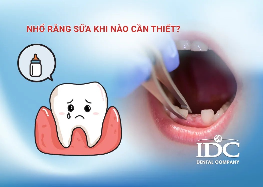 Nhổ răng sữa khi nào cần thiết?