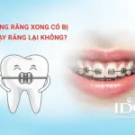 Niềng răng xong có bị chạy răng lại không?