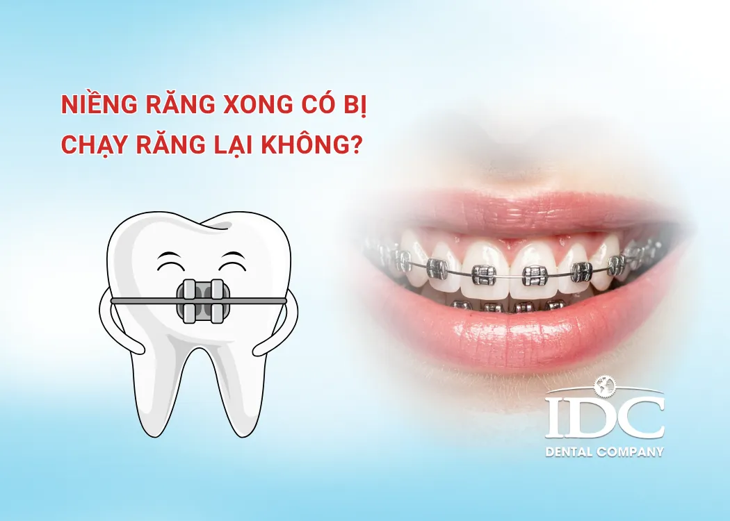 Niềng răng xong có bị chạy răng lại không?