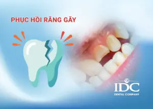 Răng cửa xấu phải làm sao? 7 Phương pháp giúp cải thiện nụ cười
