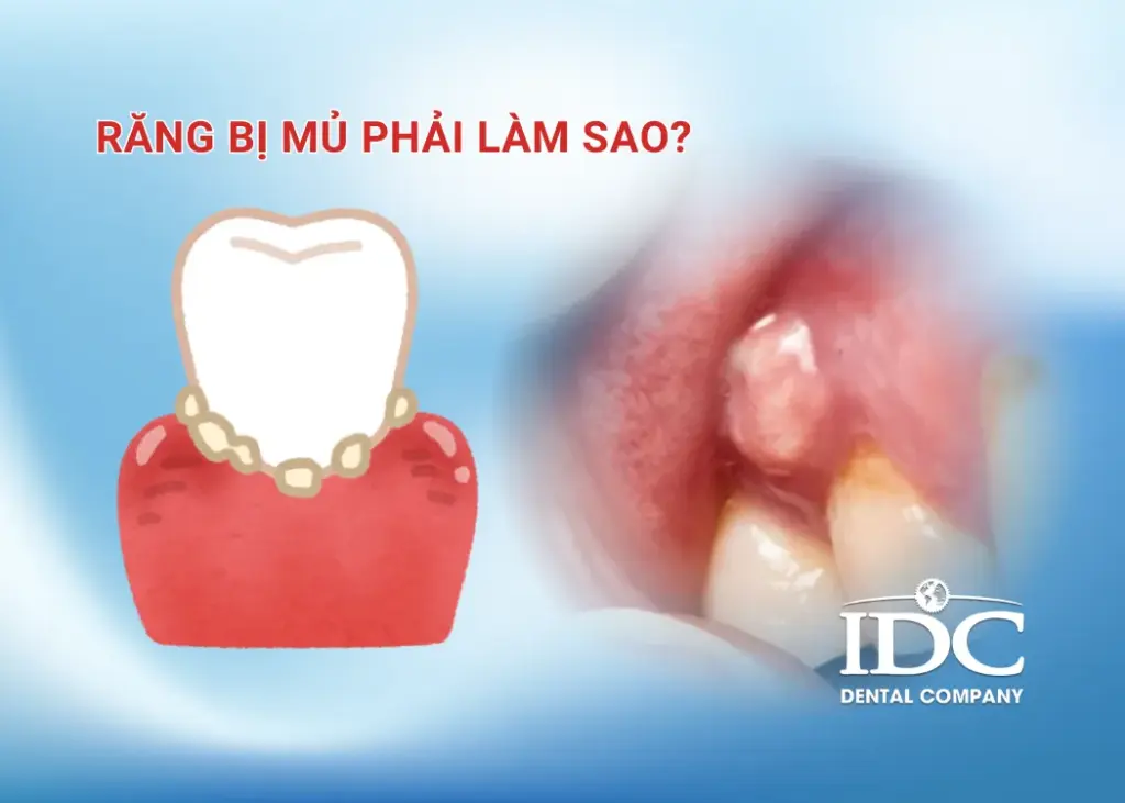 Răng bị mủ phải làm sao?