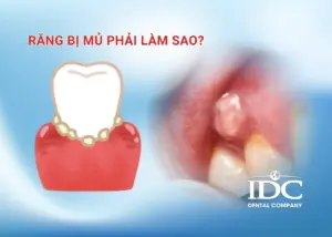 Răng bị mủ phải làm sao?