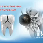 Răng bị sâu sẽ phá hỏng răng thật khi nào?