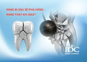 Răng chen chúc có cần niềng không? Giải pháp cho hàm răng đều đẹp