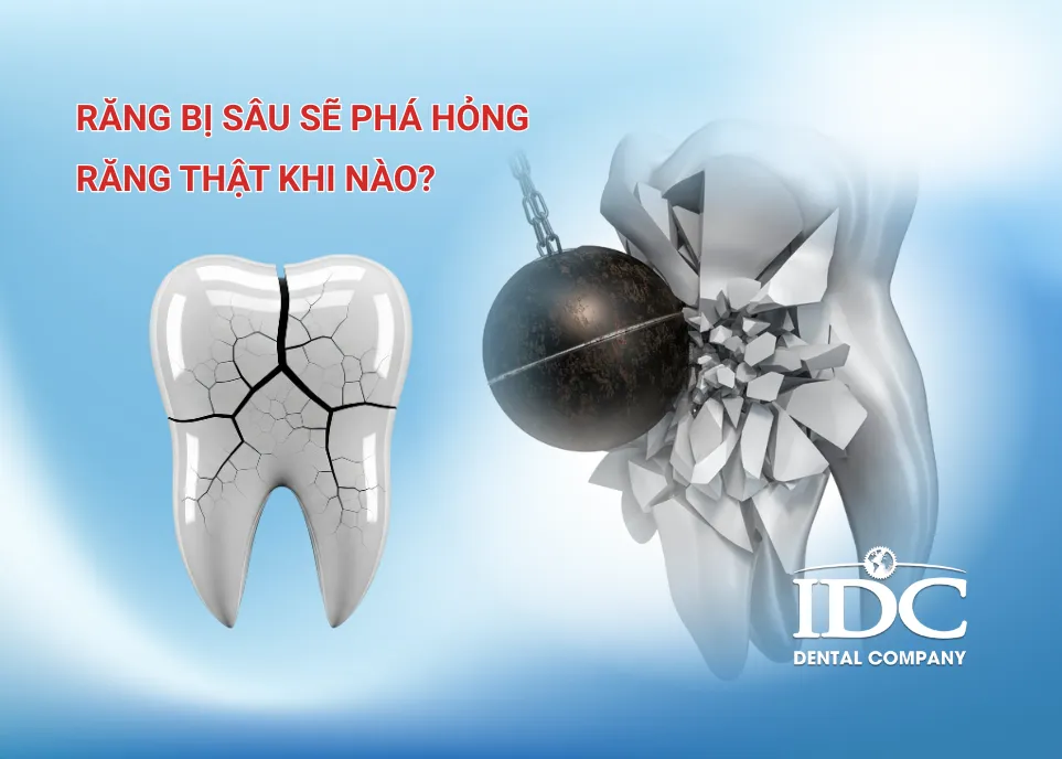 Răng bị sâu sẽ phá hỏng răng thật khi nào?