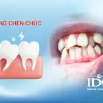 Răng chen chúc có cần niềng không?