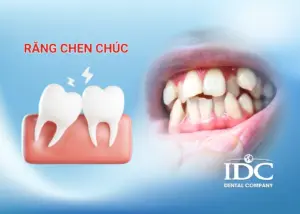 Răng chen chúc có cần niềng không?