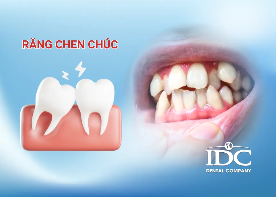 Răng chen chúc có cần niềng không?